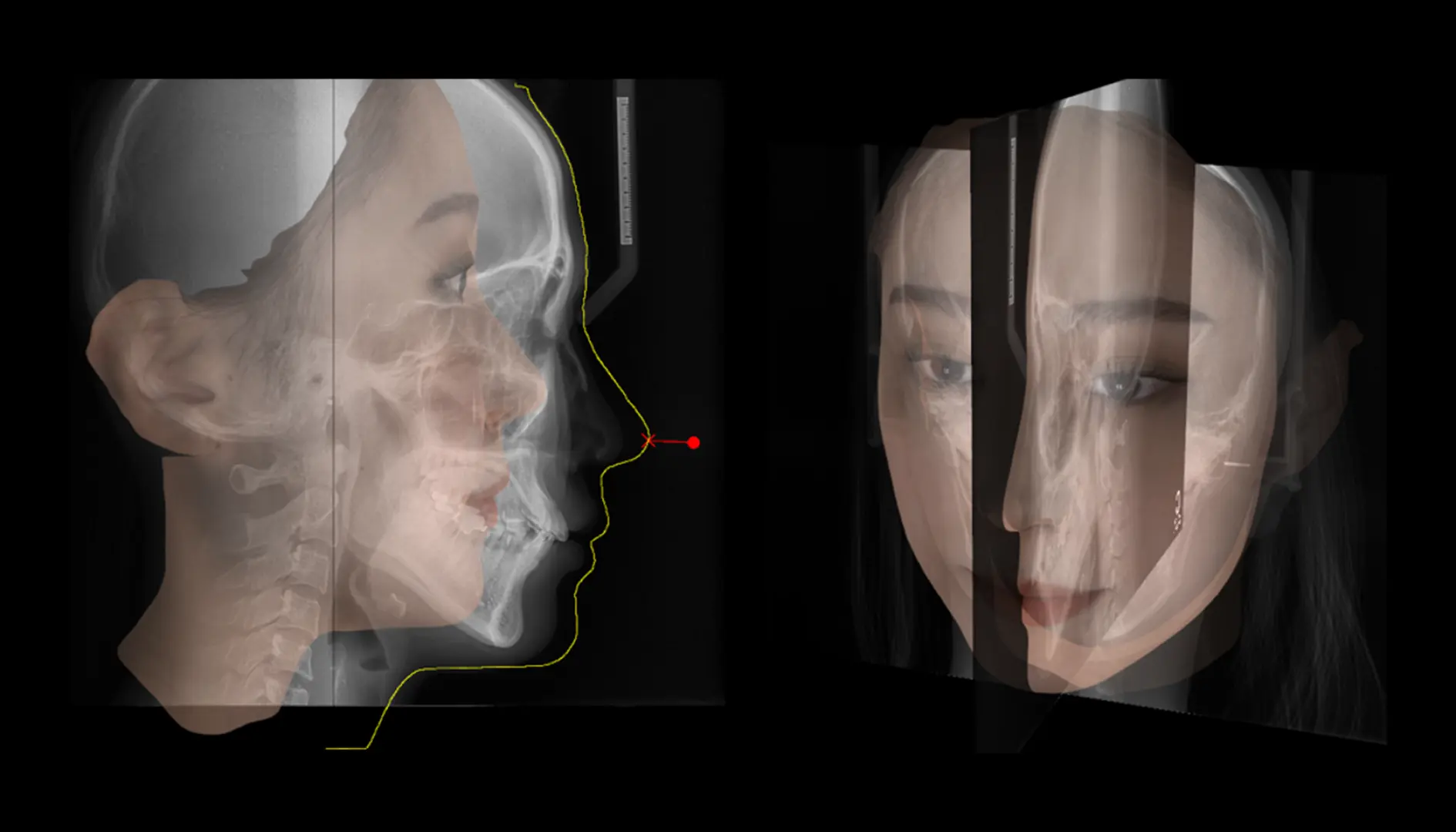 정합 (3D 얼굴 & 2D Ceph)