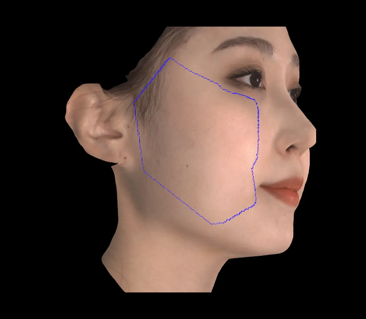 안면 리프팅 시술